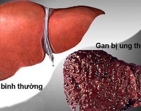 Gan nhiễm mỡ độ 1 liệu có được coi là nguy hiểm không? Tìm hiểu ngay để biêt
